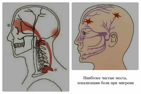 Головные боли с левой