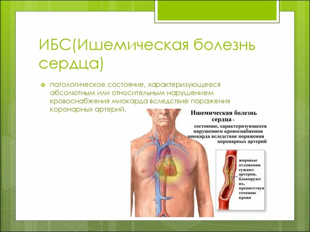 Ишемическая болезнь сердца.