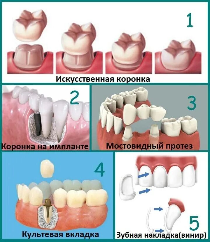 Сколько изготавливается коронка. Микропротезы виниры вкладки стоматология. Стоматологические коронки. Стоматологические коронки на зубы.