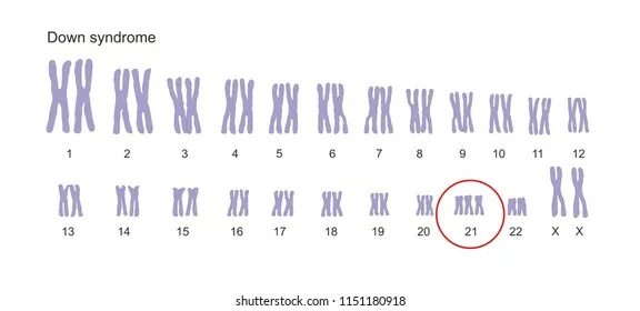 Синдром Дауна хромосомная карта. Синдром Дауна 21 хромосома. Синдром Дауна схема хромосом. Набор хромосом у человека с синдромом Дауна. Синдром дауна лишняя хромосома