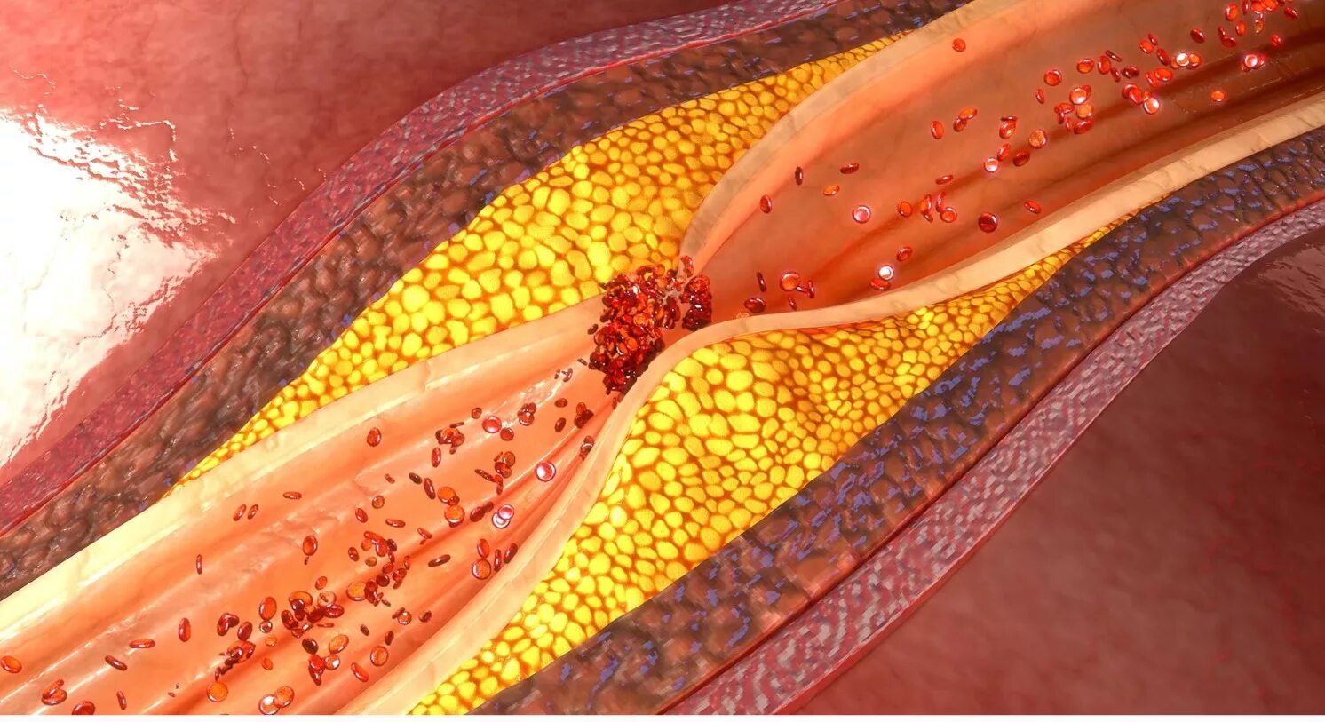 Чем чистить холестериновые бляшки. Атеросклерозная бляшка. Холестериновые бляшки в сосудах. Атеросклероз (закупорка кровеносных сосудов).