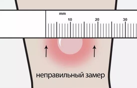 Какого размера должна быть манту у ребенка. Нормальный размер манту.