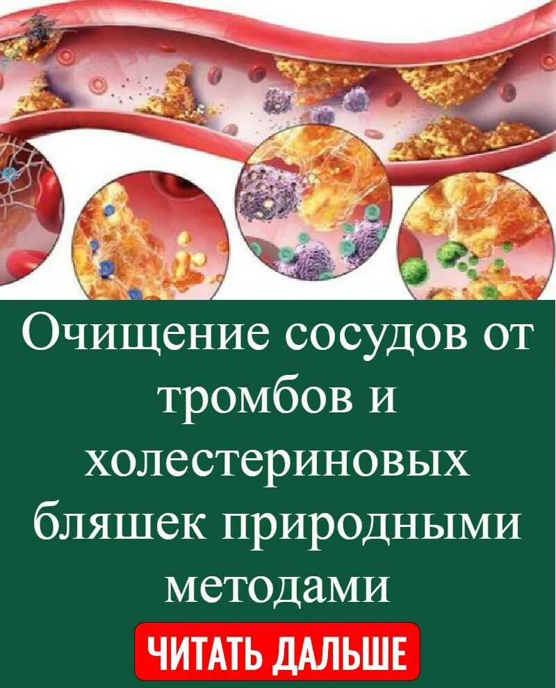 Как растворить тромб. Средства от холестериновых бляшек в сосудах. Средство для очищения сосудов от холестериновых бляшек. Препараты для чистки сосудов от холестериновых бляшек. Препарат для очищения сосудов от бляшек.