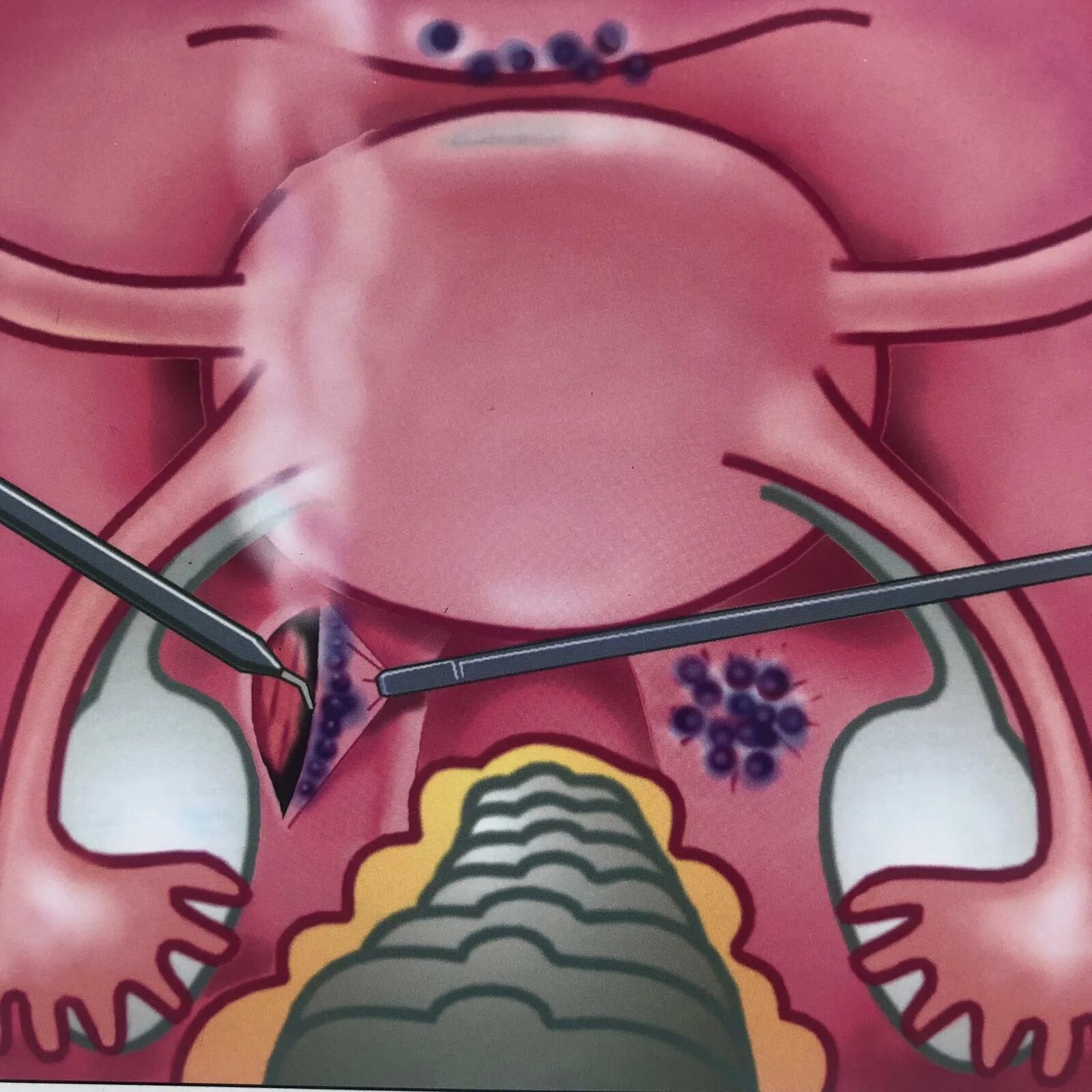 Гистерэктомия что это такое простыми. Эндометриоз мочевого пузыря. Иссечение очагов эндометриоза. Эндометриоз крестцово маточных связок. Пликация крестцово-маточных связок.