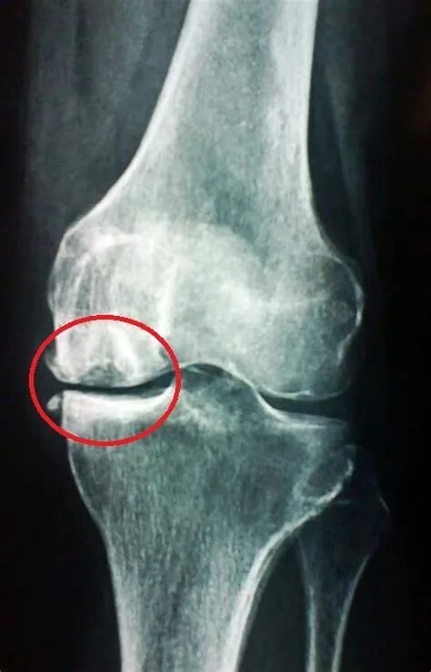 Кенига болезнь коленного сустава на рентгене. Рассекающий остеохондрит Кенига. Остеохондропатия Кенига. Рассекающий остеохондрит коленного рентген.