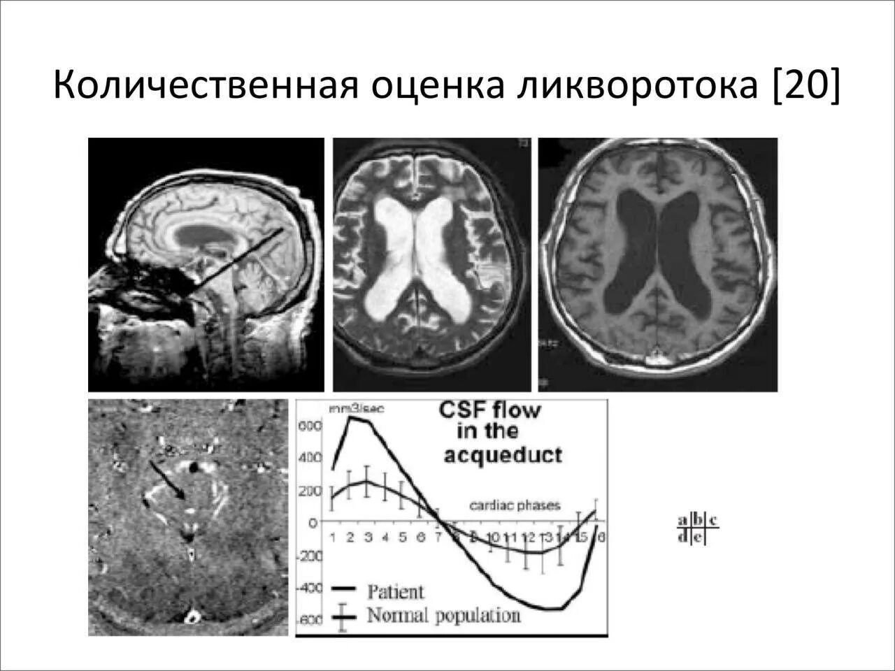 Киста головного мозга армия. Наружная гидроцефалия на кт. Гидроцефалия на кт классификация. Наружная гидроцефалия мрт. Степени гидроцефалии на кт.