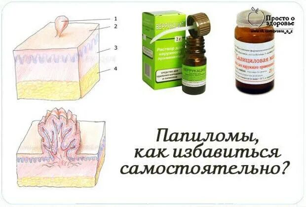 Бородавку уксусной кислотой