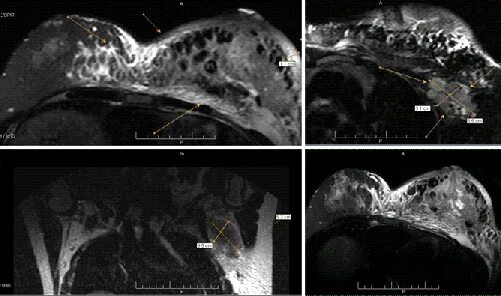 Лимфоузлы метастазы молочной железы. Магнитно-резонансная томография молочных желёз. Метастазы в лимфоузлах при мрт. Лимфоузлы молочной железы мрт. Лимфоузлы при рмж