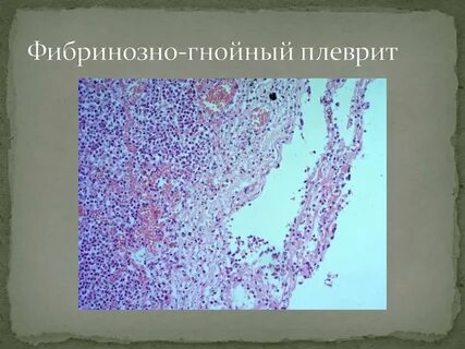 Гнойный плеврит