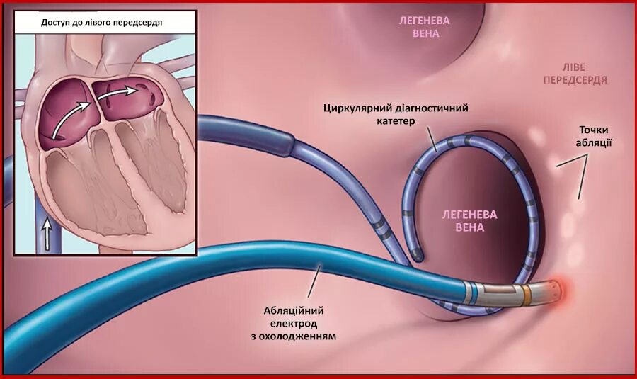 Радиочастотная катетерная абляция. Радиочастотная катетерная абляция сердца. Абляция устья легочных вен. Абляция сердца операция РЧА. Изоляция легочных вен
