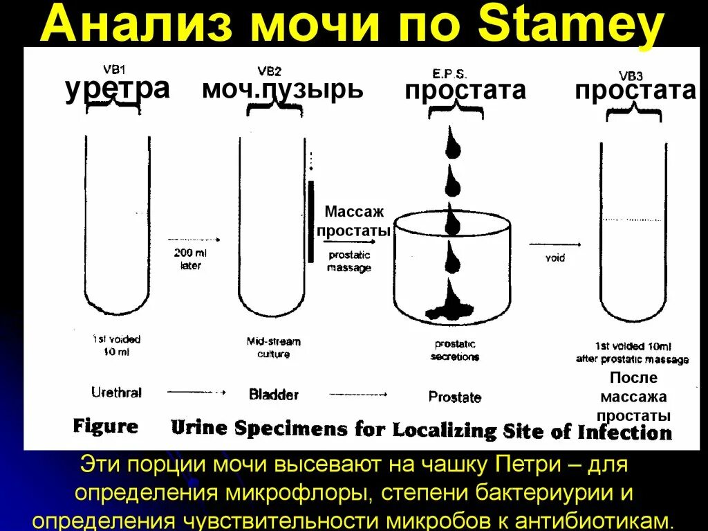 Двух стаканные пробы мочи. Исследование мочи по Stamey-Mears. Исследование мочи после массажа простаты. Анализ мочи после массажа простаты.