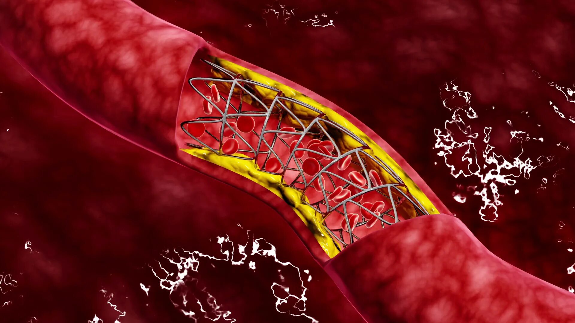 Кровь закупорка сосудов. Стентирование коронарных артерий.