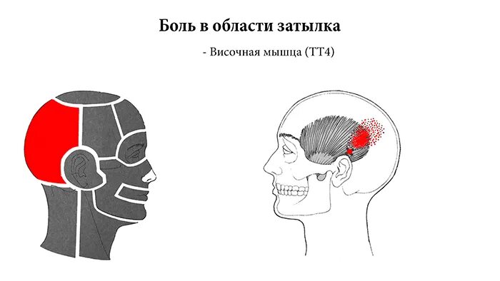 Головная в затылке. Годлвная юоль в затылке. Болит задняя часть головы.