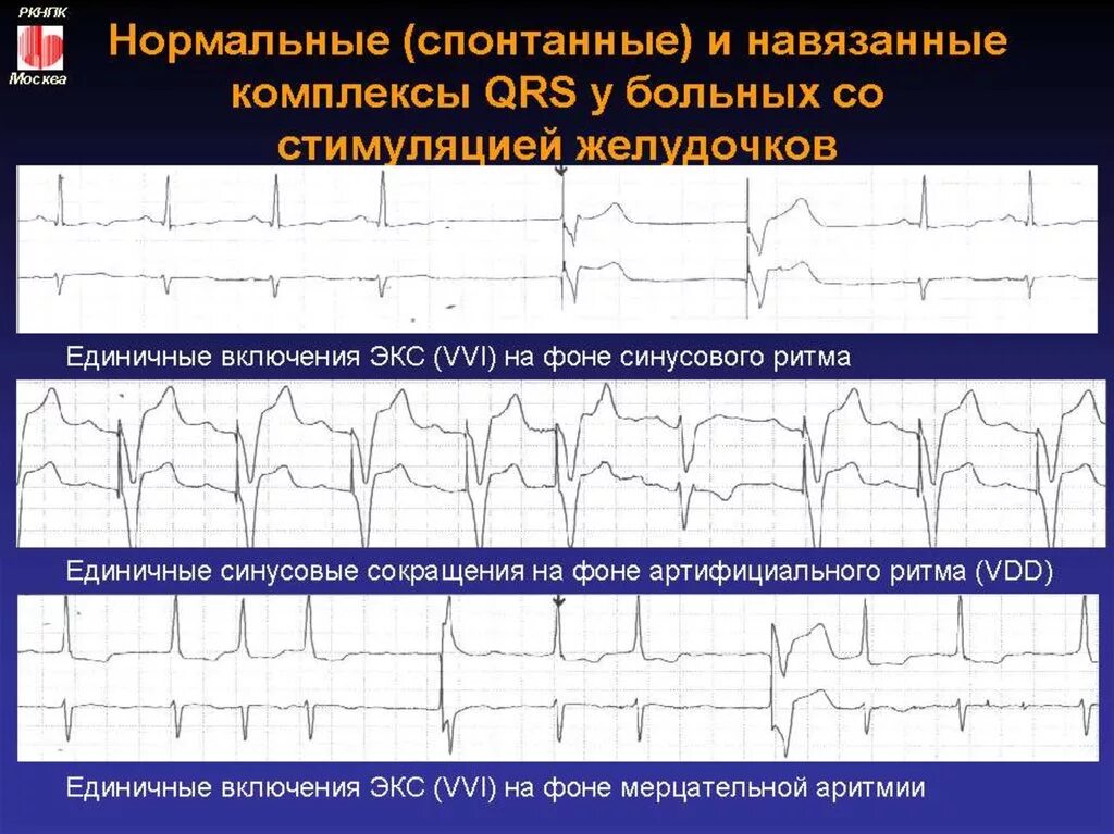 Экс примеры. Сливные желудочковые комплексы на экг с экс. заключение холтеровского мониторирования экг при кардиостимуляторе. холтеровское мониторирование фибрилляция предсердий. экс желудочковой стимуляции на экг.