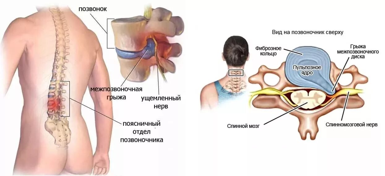 Сильные боли грыжа позвоночника. Позвоночная грыжа l1-l2. Грыжа пояснично-крестцового отдела позвоночника. Межпозвоночная грыжа поясничного отдела. Межпозвонковая грыжа симптомы.