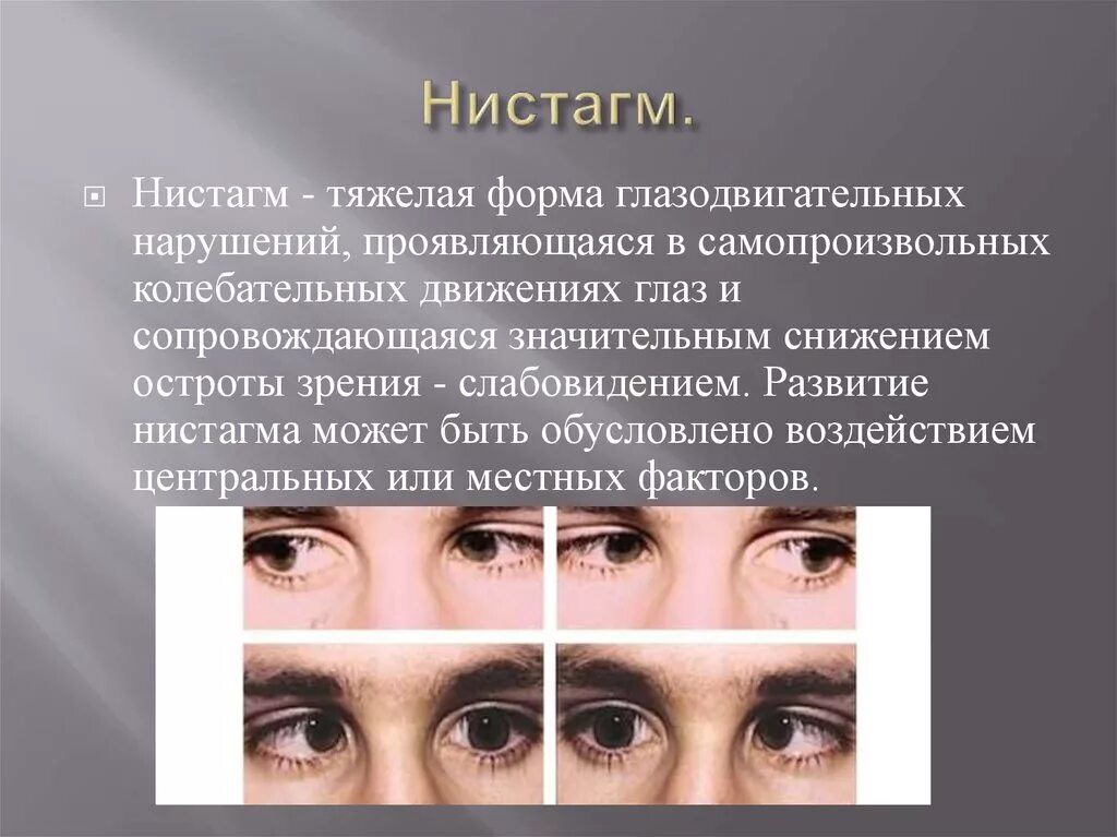Острота зрения правый глаз левый глаз. Нистагм. Горизонтальный нистагм. Горизонтальный глазной нистагм. Спонтанный горизонтальный нистагм.