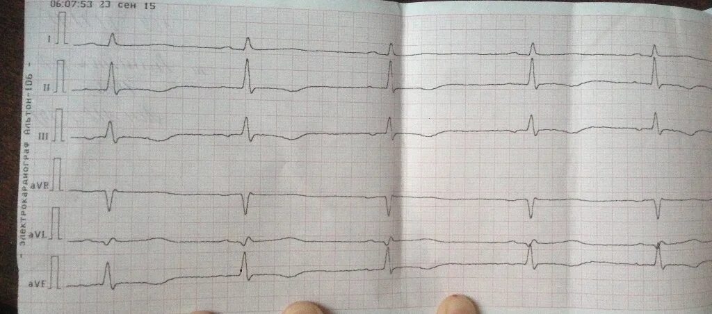 Тахисистолия это. Фибрилляция предсердий брадисистолия ЭКГ. Снимок ЭКГ С аритмией сердца. ЭКГ при ИБС аритмический вариант. Тахисистолия.