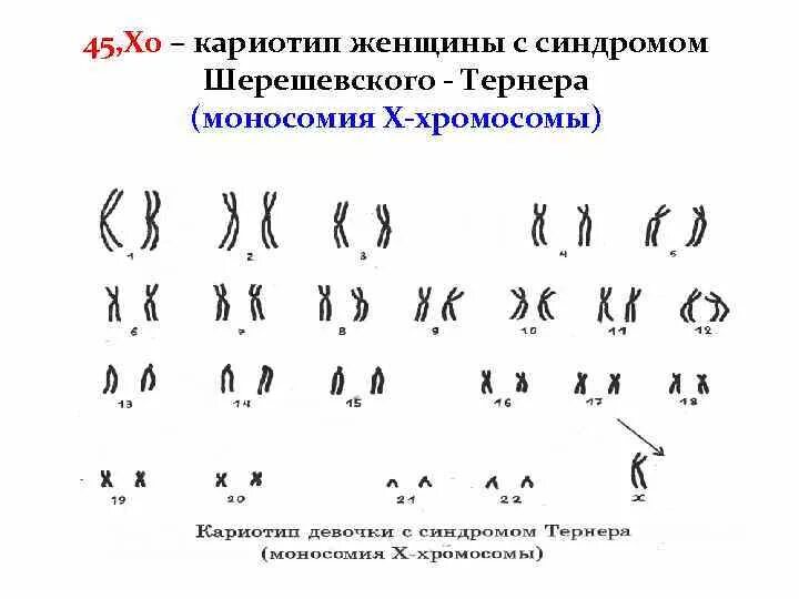 Синдром шерешевского тернера хромосомы кариотип. Синдром шерешевского тернера кариотип. кариотип больного с синдромом шерешевского-тернера. кариотип женщины с синдромом шерешевского тернера.
