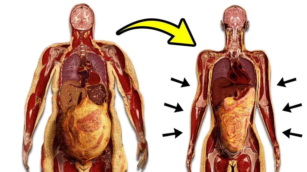 Висцеральный жир на органах. Висцеральный жир вокруг желудка. Висцеральный жир анатомия. Висцеральная жировая ткань. Толстый человек анатомия