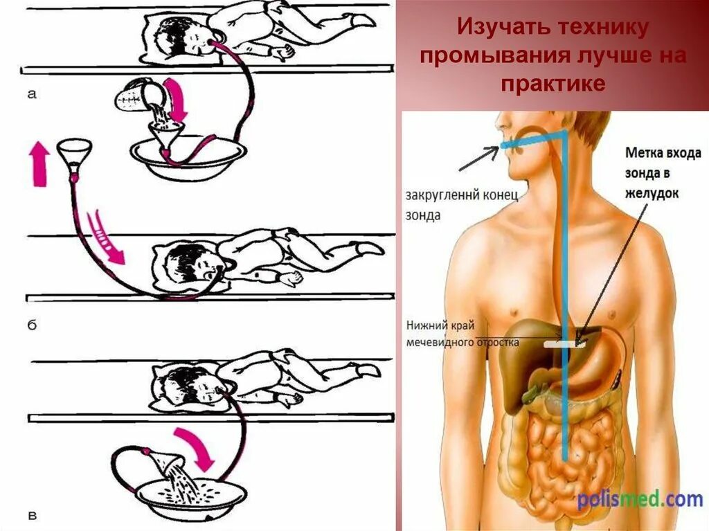 Промывание желудка через зонд. Промывание желудка. Зондовое промывание желудка. Методика проведения промывания желудка. Этапы промывания желудка.