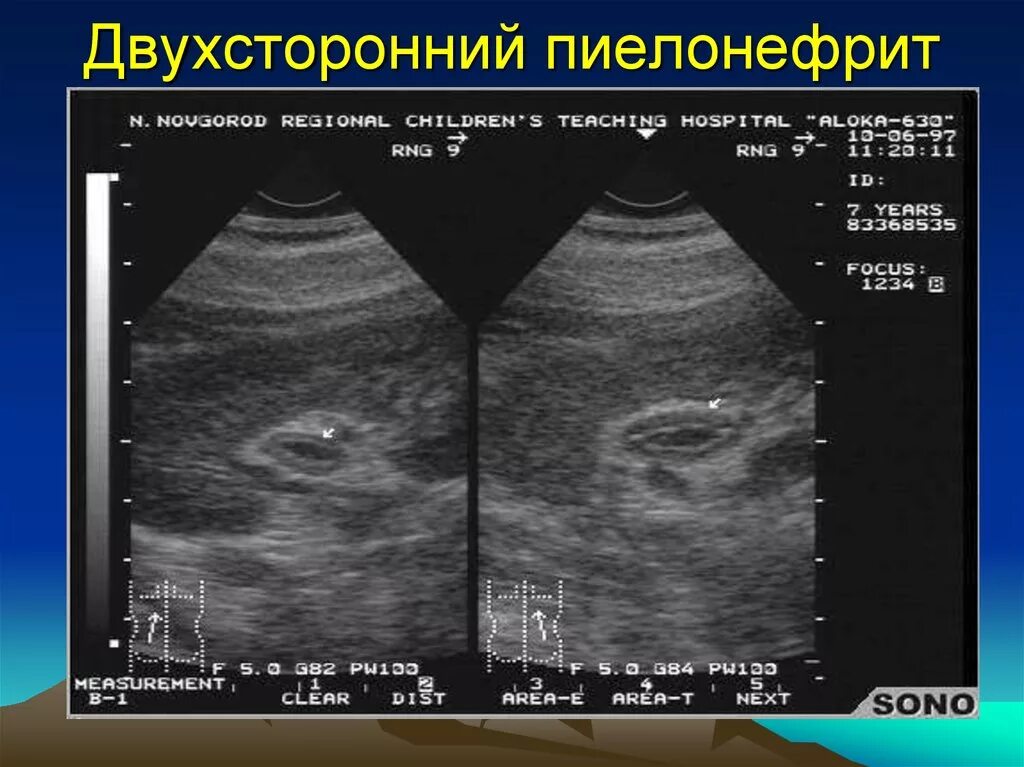 Острый пиелонефрит УЗИ картина. Хронический пиелонефрит УЗИ. Двухсторонний пиелонефрит. Изменения на УЗИ при пиелонефрите.