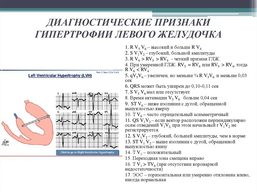 Гипертрофия левого предсердия левого желудочка. ЭКГ признаки гипертрофии миокарда лж. Критерии гипертрофии миокарда левого желудочка ЭКГ. Критерии гипертрофии левого желудочка на ЭКГ. Признаки гипертрофии лж на ЭКГ.