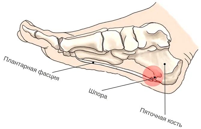 Подошвенный фасциит что это такое. Подошвенного фасциита. Фасциит стопы с внутренней стороны. Подошвенный фасциит свода стопы.