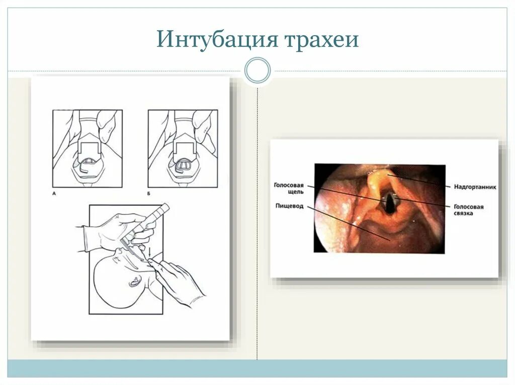 Превентивная интубация трахеи при ботулизме. Голосовая щель интубация. голосовая щель при интубации трахеи. интубация трахея пищевод.