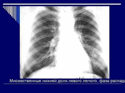 Образование левого легкого