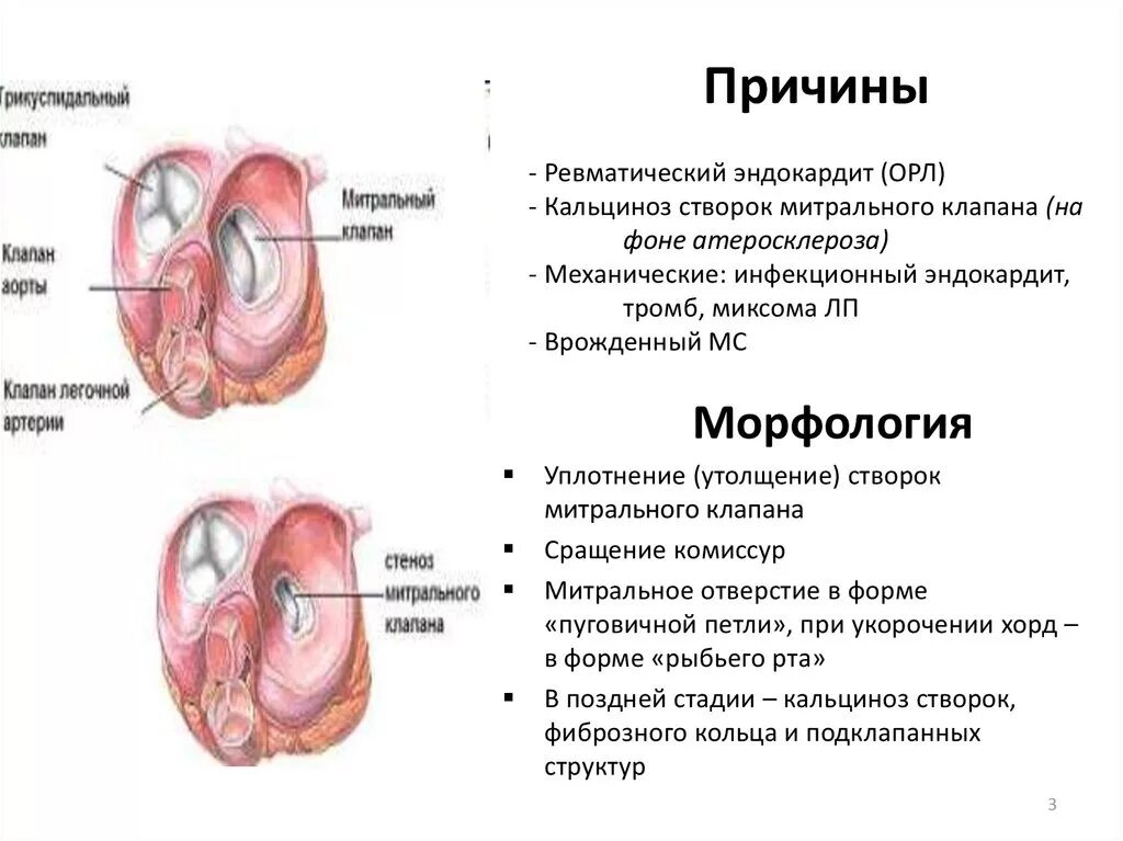 Кальциноз митрального клапана. Стеноз митрального клапана створки. Утолщение створок митрального клапана. Уплотнение стенок митрального клапана. Кальцинаты створок митрального клапана.