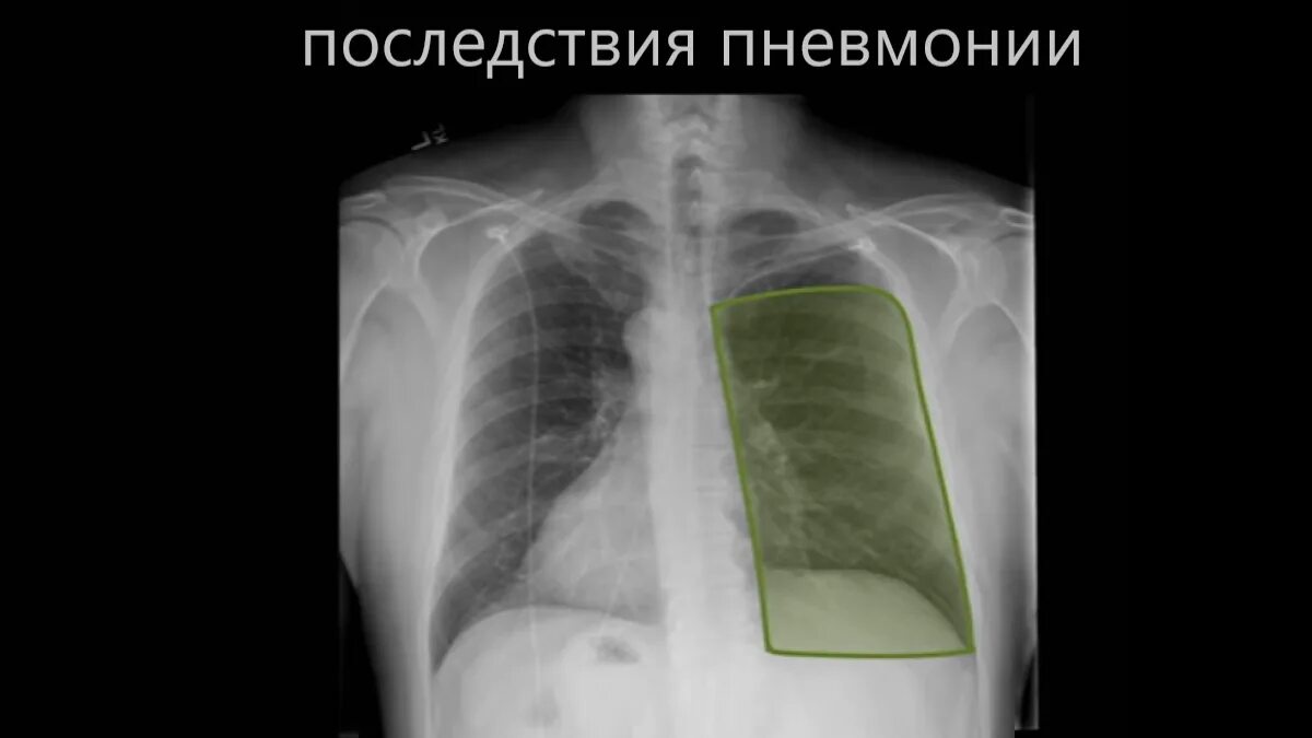 Рентген легких при ковид. Covid 19 рентген снимок легких. Последствия ковида легкие. Лёгкие при коронавирусе. Легкие при поражении коронавирусом.
