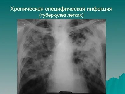 Специфические инфекции