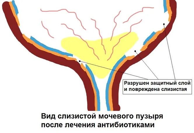 Неприятные ощущения после цистита в уретре