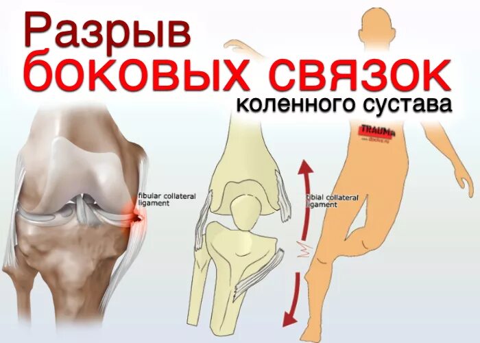 Латеральный разрыв. Разрыв внутренней боковой связки колена. Внутренняя боковая связка коленного сустава. Растяжение внутренней боковой связки. Повреждения внутренней боковой связки колена.