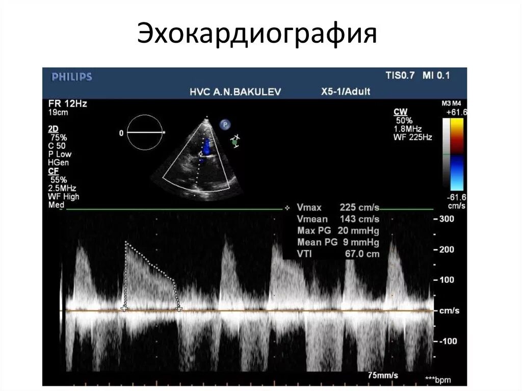 Эхо кардиография. Митральный клапан на ЭХОКГ. Норма Эхо кг сердца. PHT на ЭХОКГ. Показатели ЭХОКГ В норме.