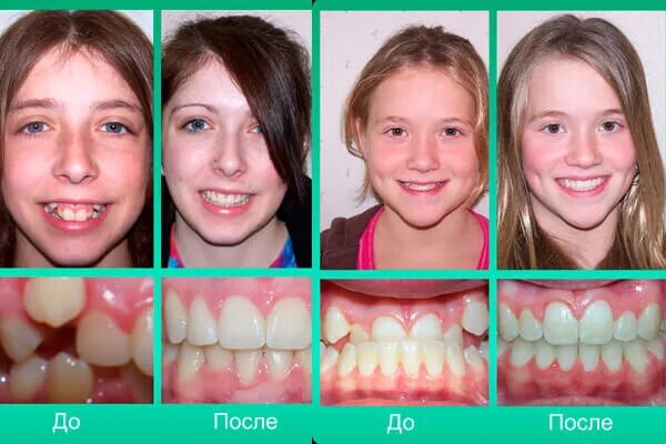 Исправление зубов до и после.