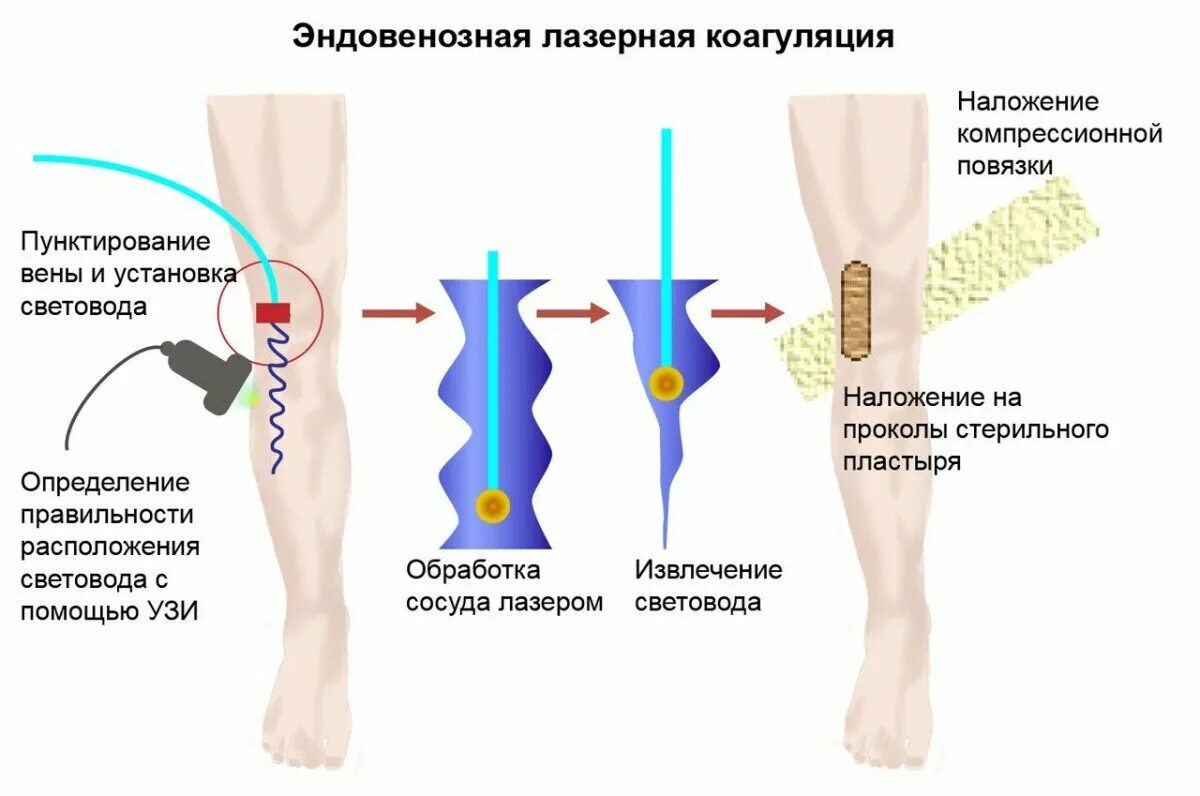 Эндовазальная лазерная коагуляция большой подкожной вены. Лазерная коагуляция ЭВЛК что это. Эндовазальная лазерная облитерация большой подкожной Вене. Эндовенозная лазерная облитерация вен нижних конечностей. Лечение вен на ногах цена