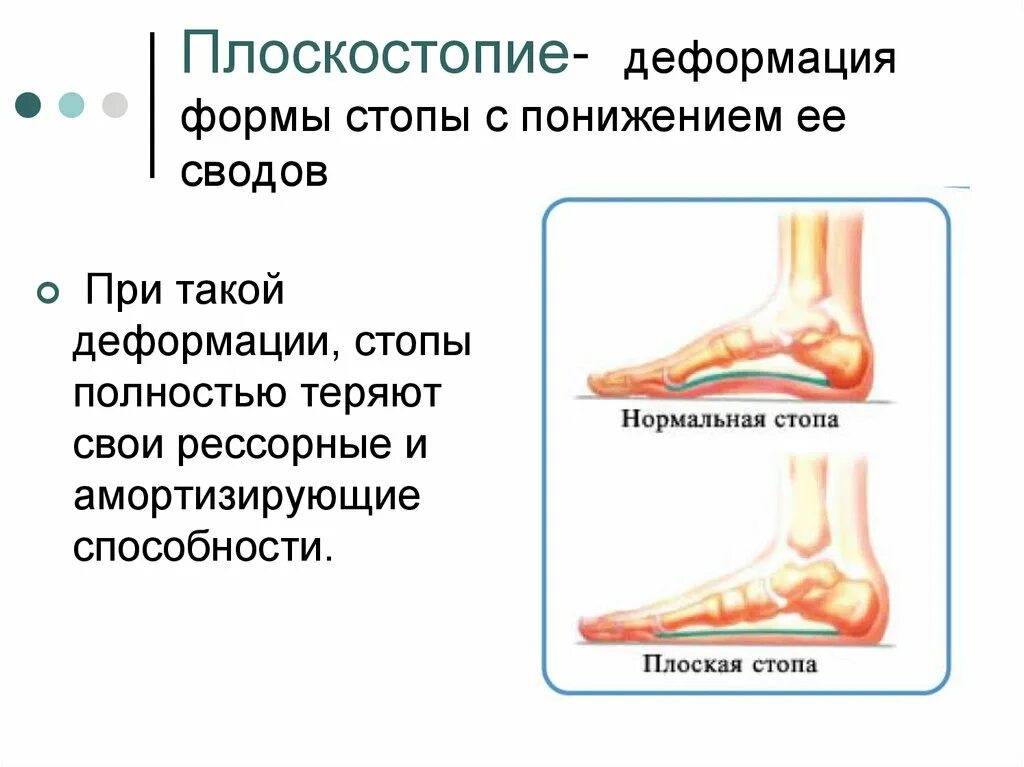 Нарушения стопы. Плоскостопие 8 класс биология. нарушение осанки и плоскостопие 8 класс. плоскостопие анатомия стопы. причины возникновения плоскостопия биология 8 класс.