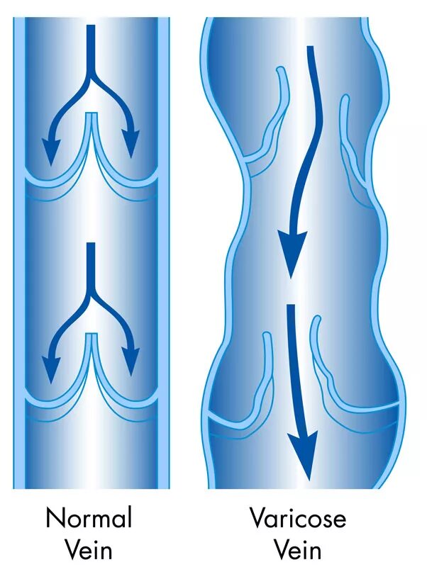 Варикозное расширение вен. Варикозное расширение овариальных вен. Варикозное расширение вен клапаны. Варикозное расширение вен нижних конечностей и малого таза. Вены ног клапаны