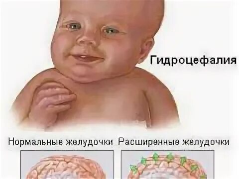 Ребенка внутренняя гидроцефалия