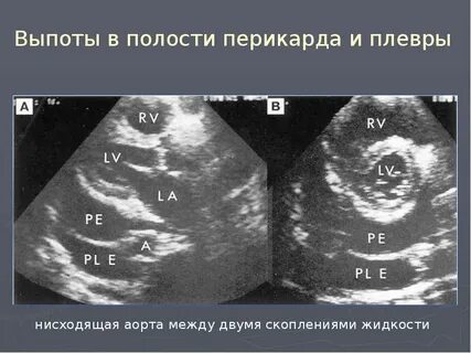 Жидкость в перикарде