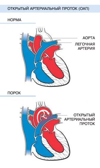 Врожденный порок сердца открытый артериальный проток. Гемодинамика при открытом боталловом протоке. Боталлов проток у новорожденных. Врожденный порок сердца открытый артериальный проток. Впс открытый артериальный проток у детей.