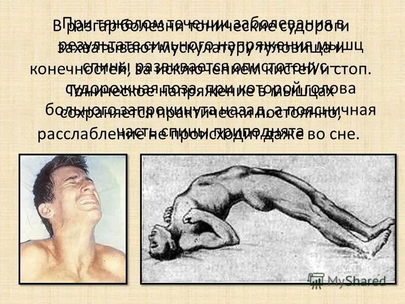 Что такое столбняк симптомы. Тризм жевательных мышц столбняк. травматический столбняк. симптом, характерный для столбняка. столбняк внешние проявления.