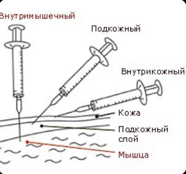 Внутримышечная внутривенная подкожная внутрикожная инъекция. Внутрикожная инъекция угол введения. Схема подкожной инъекции. Схема внутрикожного введения.