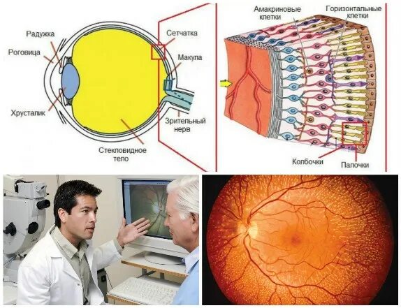 Лазерокоагуляция сетчатки глаза. Лазерное укрепление сетчатки. Сетчатка восстановление лекарство.
