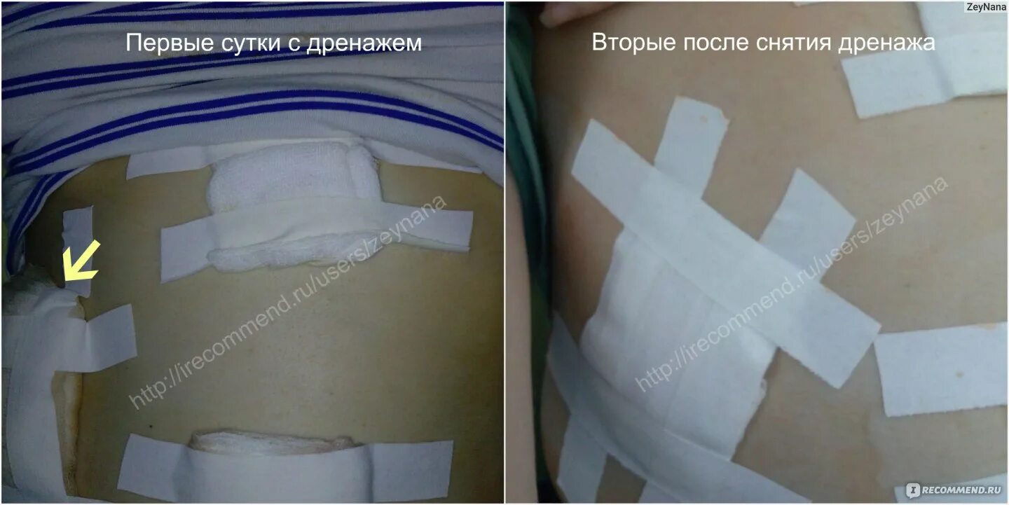 Когда снимать компрессионные чулки после лапароскопии. Бандаж после операции желчного пузыря. дренаж после операции лапароскопии. послеоперационный бандаж лапароскопия. дренаж после холецистэктомии.
