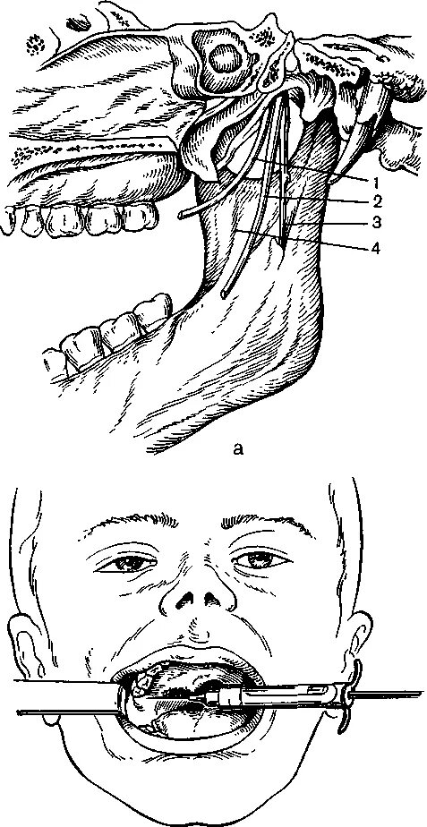 Анестезия по гейтсу. Проводниковая анестезия нижней челюсти мандибулярная. Инфильтрационная анестезия челюсти. Резцовая проводниковая анестезия. Мандибулярная анестезия нижней челюсти.