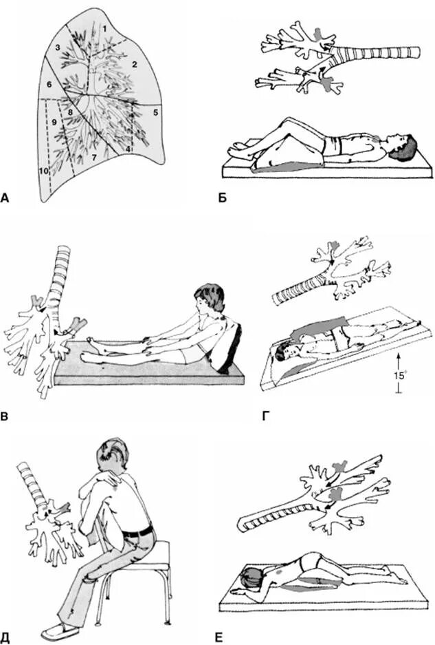 Постуральный дренаж вибрационный массаж детям. Постуральный дренаж при бронхите для отхождения мокроты. Дренажные положения для отхождения мокроты. Постуральный дренаж массаж грудной клетки. Постуральный массаж