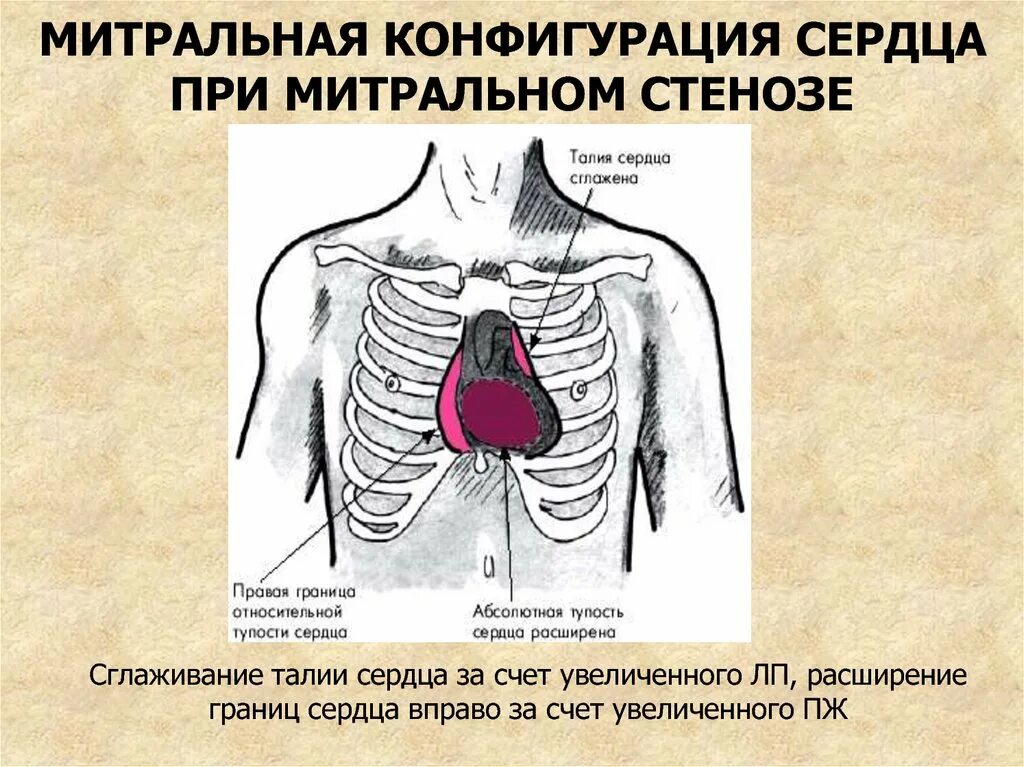 Норма форма сердца. Конфигурация сердца при митральном стенозе. Митральная и аортальная конфигурация сердца. Митральная конфигурация сердца патология. Митральная недостаточность границы относительной тупости.