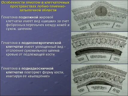 Особенности гематом